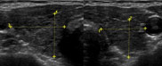 慢性甲状腺炎、類似のエコー所見